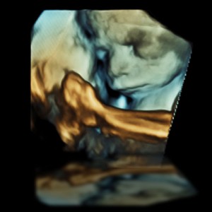 3D-Ultraschall